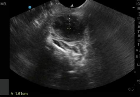 Ultrasound Of The Month Peritonsillar Abscess — Taming The Sru