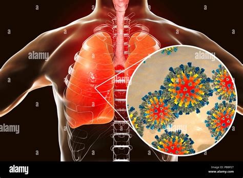 Neumon A Causada Por Virus Del Sarampi N Fotograf As E Im Genes De Alta