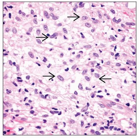 Mycobacteria Leprae Infection Basicmedical Key