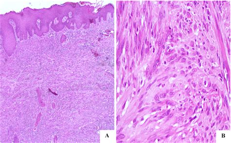 Hematoxylin And Eosin Staining Of A Pseudomyogenic Download