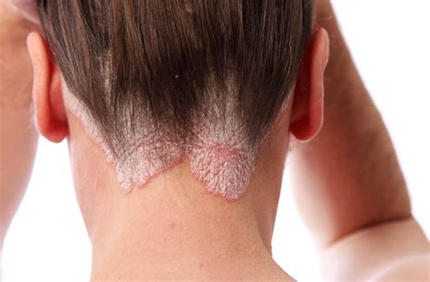 Plaque psoriasis scalp pictures | Symptoms and pictures