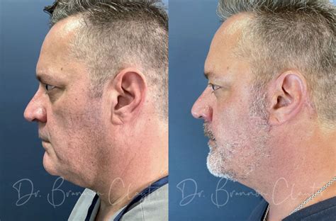 Mens Facelifts Get Masculine Natural Looking Results Dr Claytor