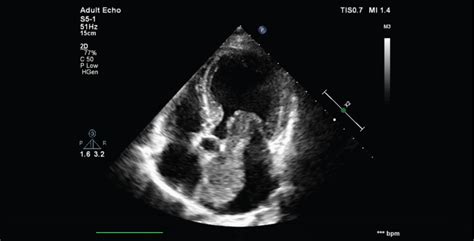 Large Left Atrium Myxoma Protruding Into Left Ventricle