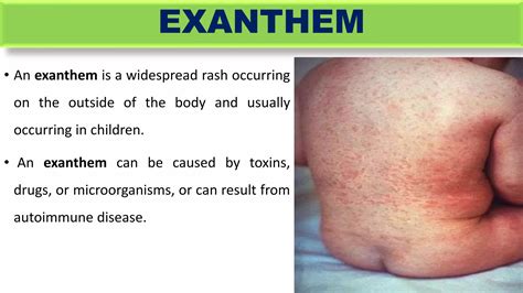 Maternal Infection During Pregnancy Ppt