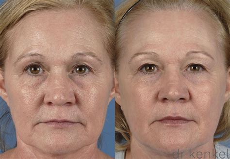 Laser Skin Resurfacing In Dallas And Frisco Tx Dr Jeffrey Kenkel