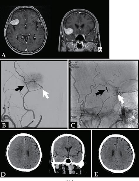 Figure From Chronic Subdural Hematoma After Craniotomy With