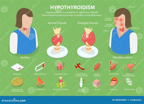 3d Isometric Flat Vector Conceptual Illustration Of Hypothyroidism