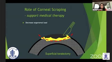 Corneal Scraping Essential Tool Complimenting Empirical Anti Infective