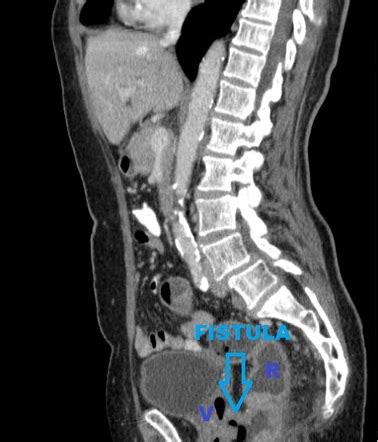 Rectovaginal Fistula Radiology Reference Article Radiopaedia Org