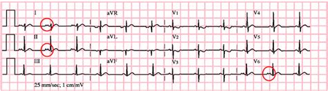 P mitrale EKG Medicína nemoci studium na 1 LF UK