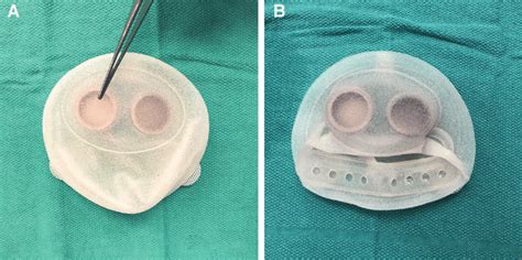 Sientra Allox2 Tissue Expander A Forceps Pointing To The Drain Port Download Scientific