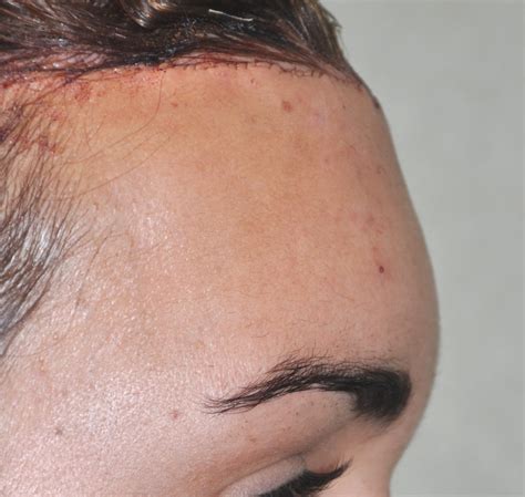 Plastic Surgery Case Study Frontal Hairline Advancement With Frontal