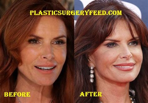 Roma Downey Plastic Surgery - Plastic Surgery Feed