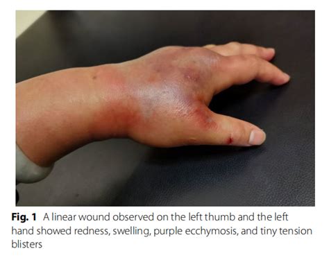 Severe Skin And Soft Tissue Infection In The Left Upper Limb Caused By