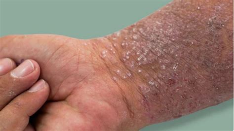 Different Types Of Itchy Skin Rashes 57 Off