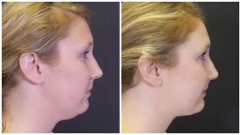 Pin On Chin Liposuction