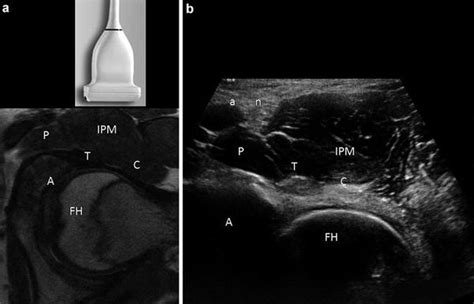 Hip Joint Injection Ultrasound