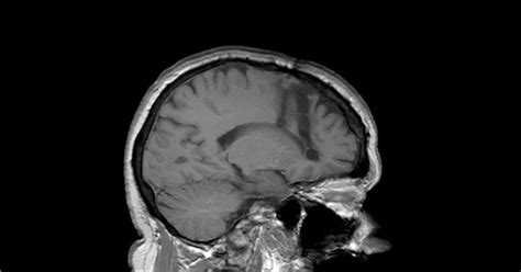 The effects of cerebral lobotomy: a summary.