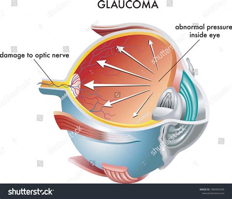 Medical Illustration Causes Glaucoma Stock Vector Royalty Free 1985096390 Shutterstock