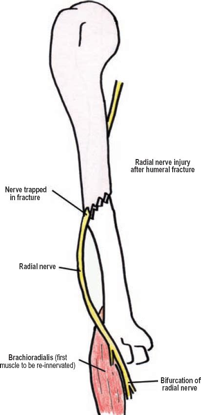 Radial Groove Radial Nerve