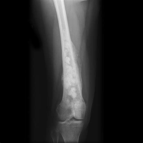 Osteosarcoma Radiology