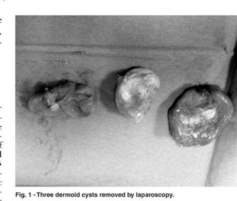 Figure 1 From An Unusual Case Of Multiple And Bilateral Ovarian Dermoid