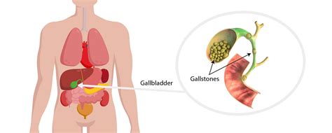 Gallstones Harbour Surgery Centre