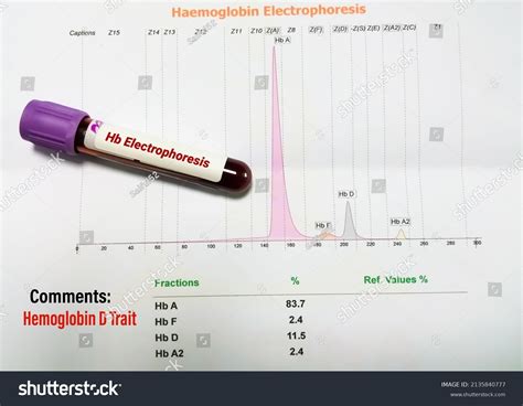 31 Hemoglobin electrophoresis Images, Stock Photos & Vectors | Shutterstock