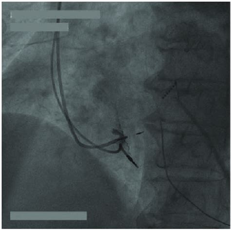 Fluoroscopic Image In A Left Anterior Oblique Projection Of 30 With