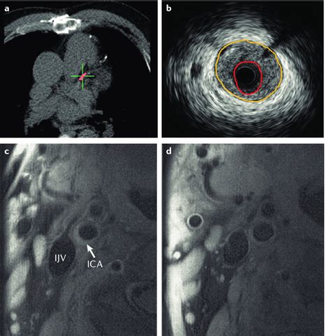 Imaging Of Atherosclerotic Plaque Burden A CT Calcium Scoring