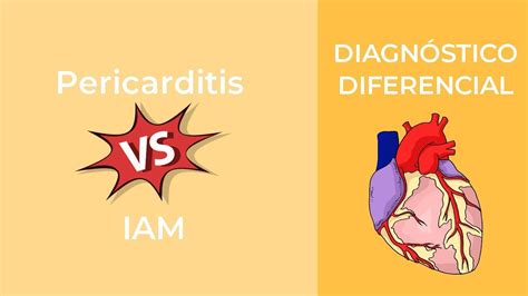 Diagn Stico Diferencial Pericarditis Vs Iam Youtube