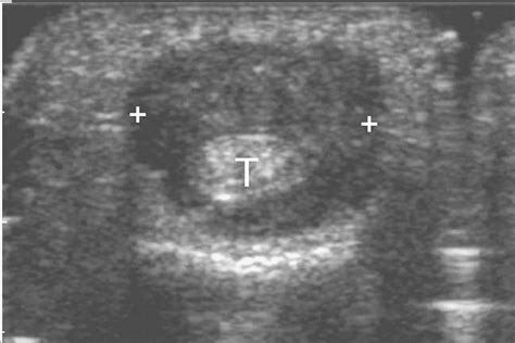 Giant Cell Tumor Of Tendon Sheath Ultrasound