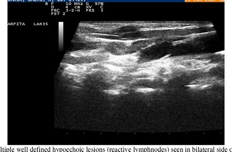 Figure 2 From Ultrasongraphic And Colour Doppler Evaluation Of Cervical