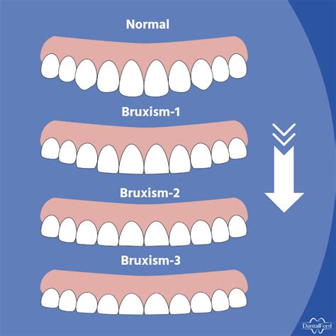 What Is Bruxism Teeth Grinding Causes And Treatment