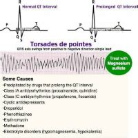 Torsades de Pointes