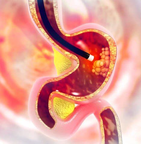 upper endoscopy nyc  endoscopy doctor upper east side