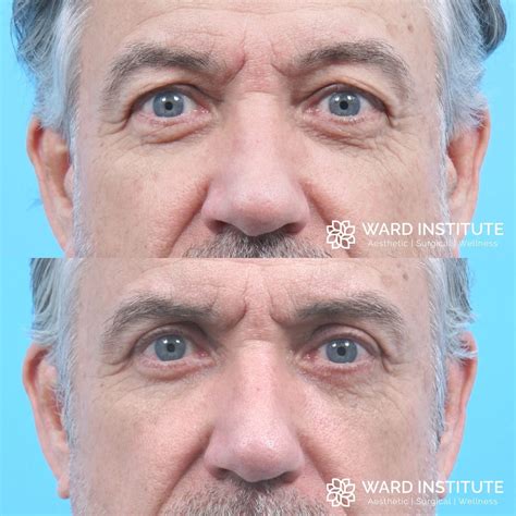 Blepharoplasty Plastic Surgery In Slc Ut Ward Institute