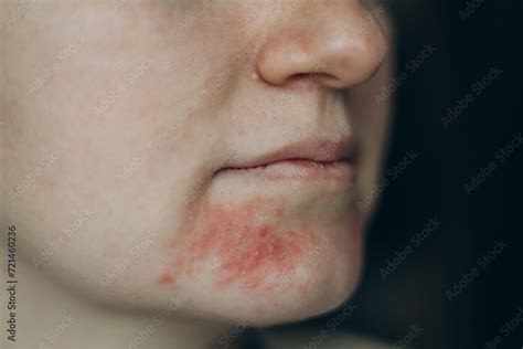 Perioral Dermatitis On Woman Face Closeup Dermatitis On Skin Ill