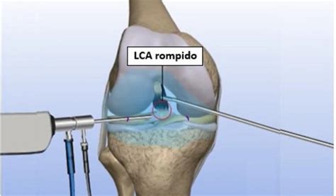 O Que É Cirurgia De Lca - Cirurgia Joelho no ligamento LCA | Vaquinhas online