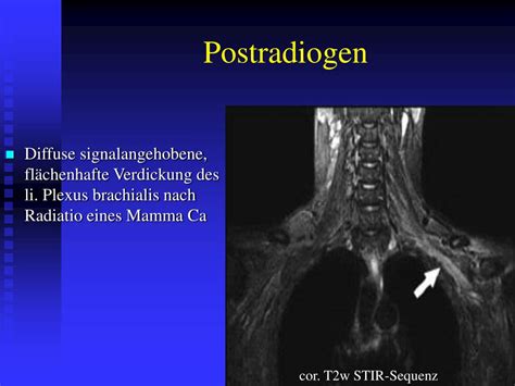 PPT MRT bei Plexus brachialis Läsionen PowerPoint Presentation free