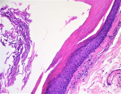 Eyelid Cyst Histology