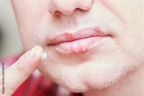 Herpes Infection On Lips Treatment Lipstutorial Org