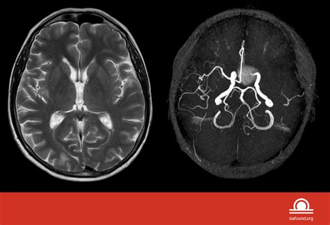 cerebral aneurysm angiogram
