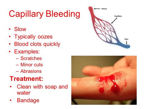 Supply First Aid TYPES OF BLEEDING: Bleeding Is Of Types, 59% OFF