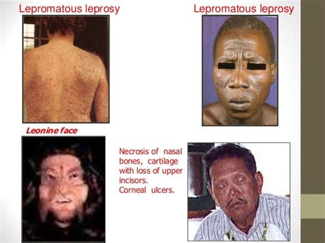 Mycobacterium leprae