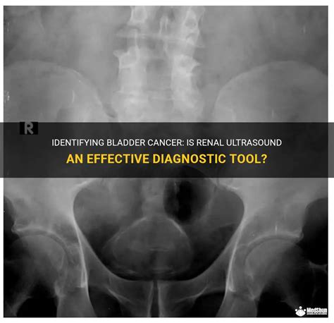 Identifying Bladder Cancer Is Renal Ultrasound An Effective Diagnostic