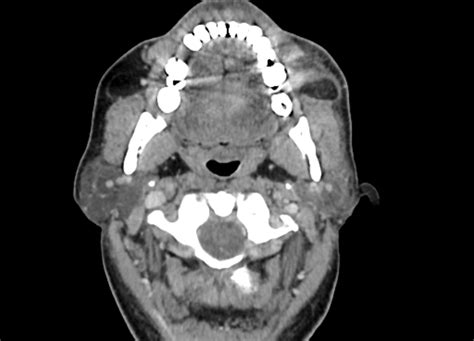 Sialolithiasis Parotid Image