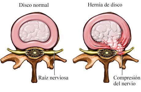 Consejos Para Tratar Un Nervio Comprimido Blog De Farmacia