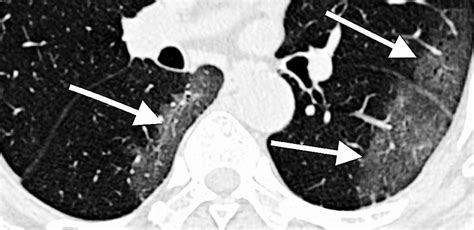 NIH Harnesses Artificial Intelligence For COVID 19 Diagnosis Treatment