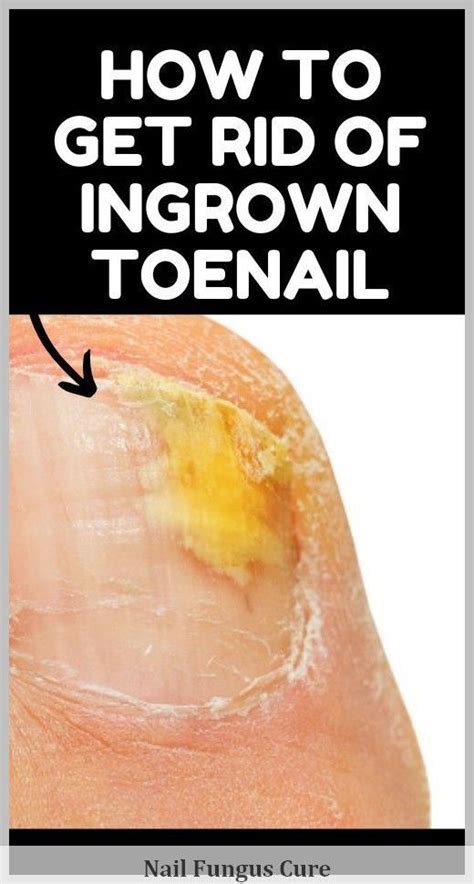 Toenail Fungus Symptoms Causes And Support Strategies Artofit